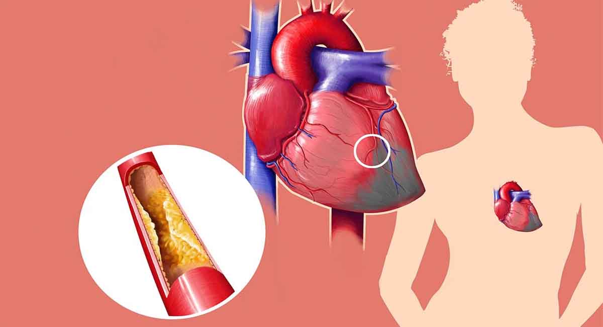 High Cholesterol Increases the Risk of Heart Attack, So Avoid Including These Things in Breakfast